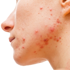 How to Get Rid of Acne Scars with Effective Skincare Products and Treatments