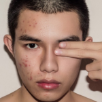 Get Rid of Acne Once and For All: The Complete Solution for Clear Skin