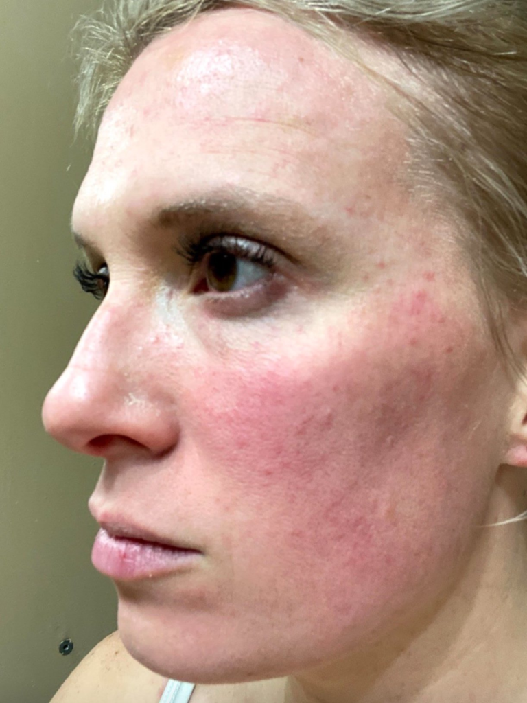 Unlock the Secrets to Clear Skin: Your Guide to Treating Rosacea